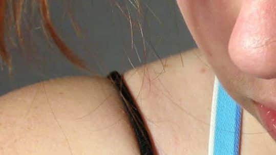 Female Sudden Hair Loss - Hair Transplants