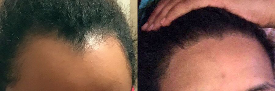 37 Year Old African Female Black FUT Hair Transplant Before / After Result  Hair Restoration Centers