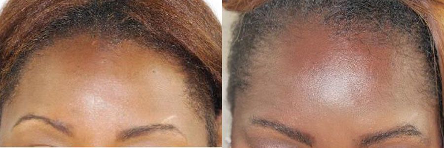 34 Year Old African Female Black FUT Hair Transplant Before / After Example
