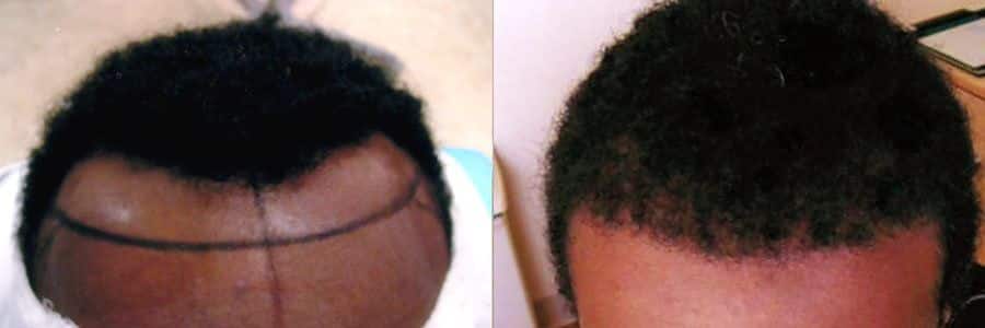 53 Year Old African Male Black FUT Hair Transplant Before / After Result