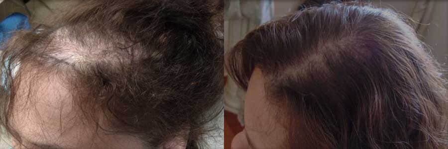 FUE Hair Transplant - Female Before and After
