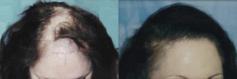 41 Year Old Caucasian Female Brown FUT Hair Transplant Before / After Example