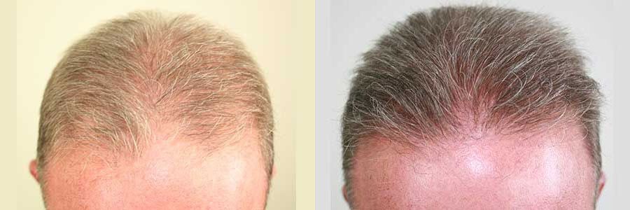 62 Year Old Caucasian Male Dark Blonde FUE Hair Transplant Before / After Example