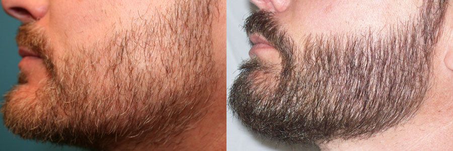39 Year Old Caucasian Male Brown Facial Hair Transplant Before / After  Example - Hair Restoration Centers