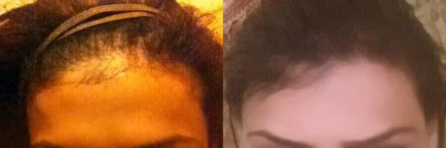 31 Year Old Indian Female Black FUT Hair Transplant Before / After Result