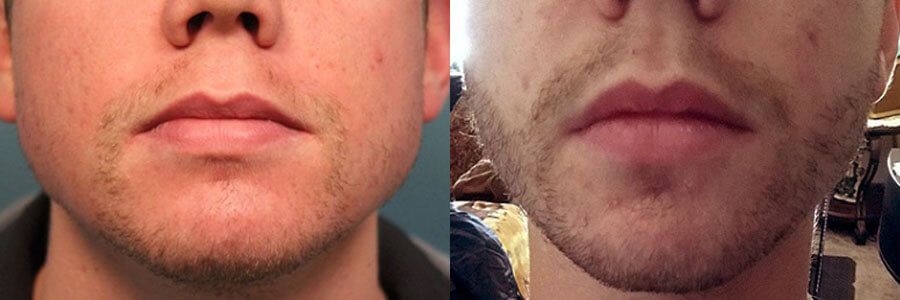 32 Year Old Caucasian Male Blonde Facial Hair Transplant Before/After Example