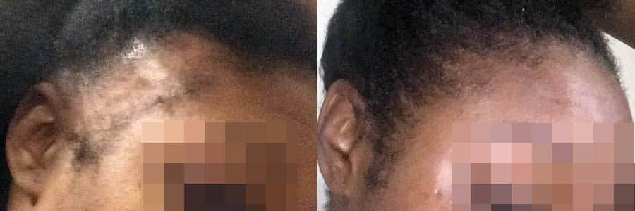 32 Year Old African Female Black FUT Hair Transplant Before/After Example
