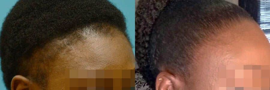 35 Year Old African Female Black FUT Hair Transplant Before/After Result