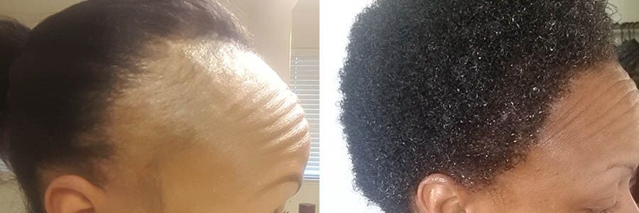 42 Year Old African Female Black FUT Hair Transplant Before/After Example