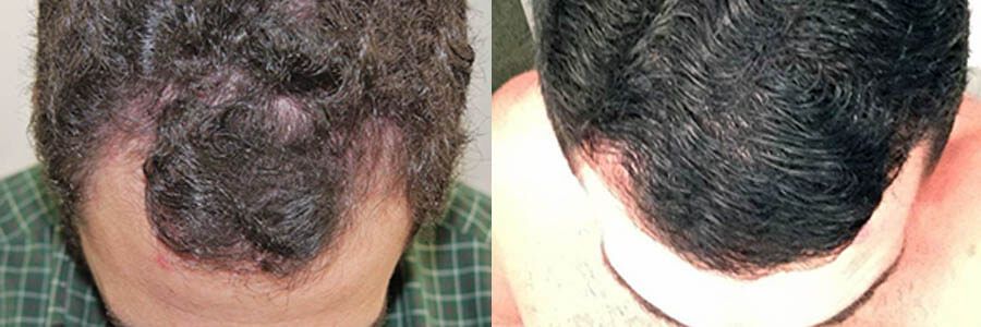 56 Year Old Caucasian Male Black FUT Hair Transplant Before/After Result