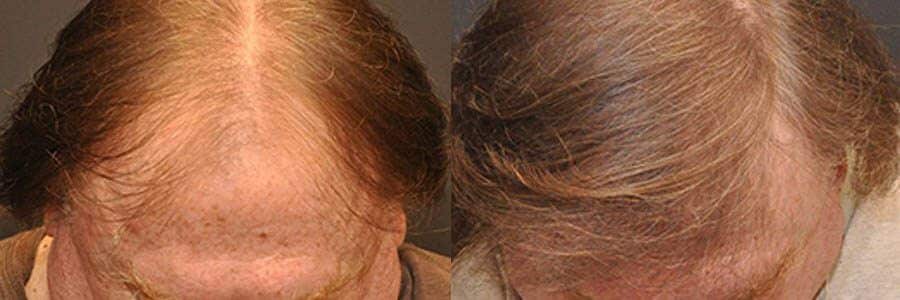 61 Year Old Caucasian Male Red FUT Hair Transplant Before/After Example