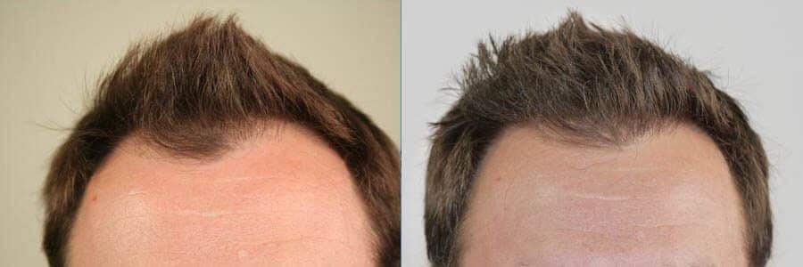 38 Year Old Caucasian Male Brown FUT Hair Transplant Before/After Example