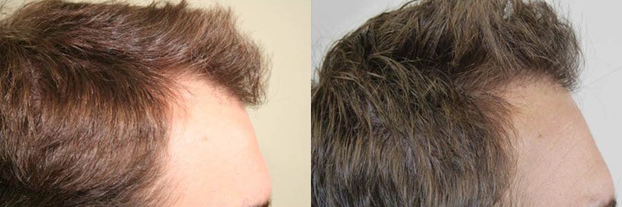 FUT Hair Transplant - Male Before and Afterer