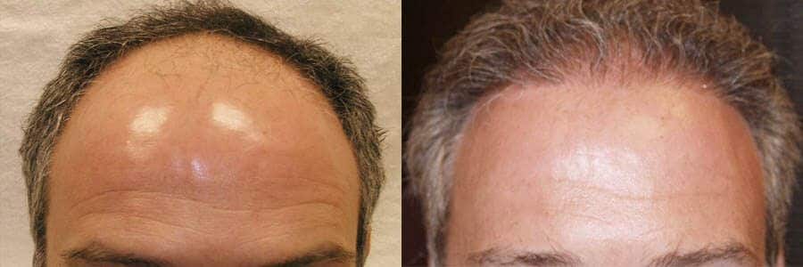 71 Year Old Caucasian Male Brown / Gray FUT Hair Transplant Before/After Result