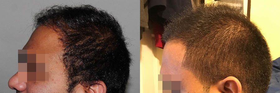 39 Year Old Indian Male Black FUE Hair Transplant Before/After Example -  Hair Restoration Centers