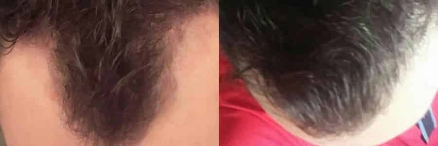 27 Year Old Caucasian Male Brown FUT Hair Transplant Before/After Result