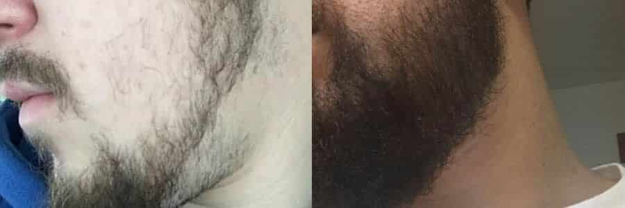 33 Year Old Caucasian Male Brown Facial Hair Transplant Before/After  Example - Hair Restoration Centers