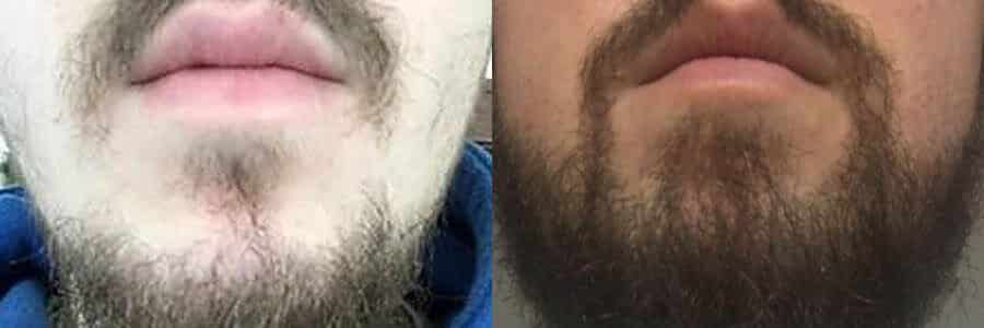 33 Year Old Caucasian Male Brown Facial Hair Transplant Before/After Example