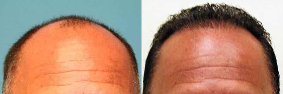 54 Year Old Caucasian Male Brown FUT Hair Transplant Before/After Result