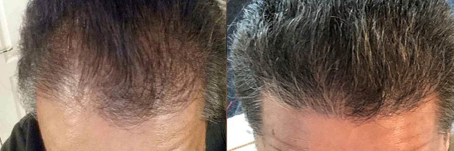58 Year Old Caucasian Male Black FUT Hair Transplant Before/After Example