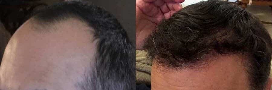 45 Year Old Caucasian Male Brown FUE Hair Transplant Before/After Result