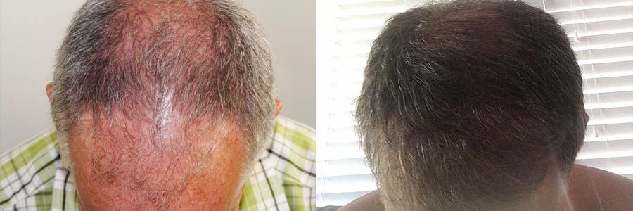 72 Year Old Caucasian Male Gray FUT Hair Transplant Before/After Example