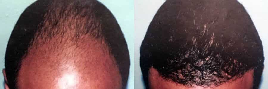 39 Year Old African Male Black FUT Hair Transplant Before/After Example -  Hair Restoration Centers
