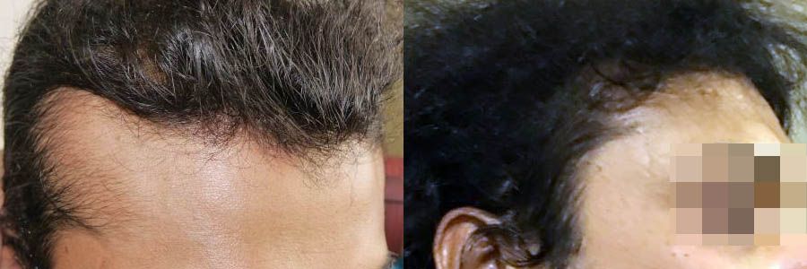 38 Year Old Indian Male Black FUT Hair Transplant Before/After Example