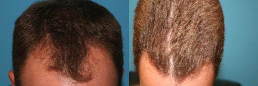 40 Year Old Caucasian Male Dark Blonde FUT Hair Transplant Before/After Result