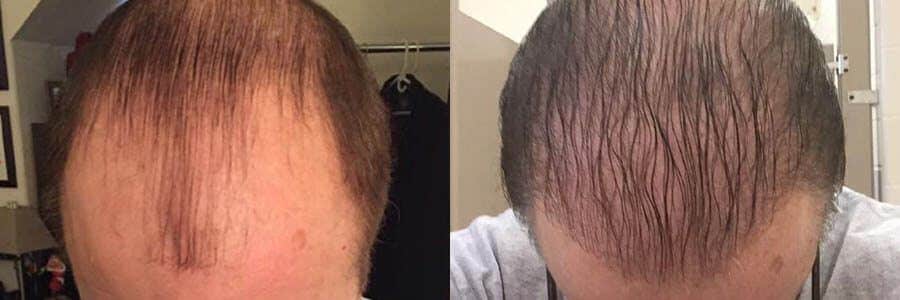 44 Year Old Caucasian Male Brown FUT Hair Transplant Before/After Example