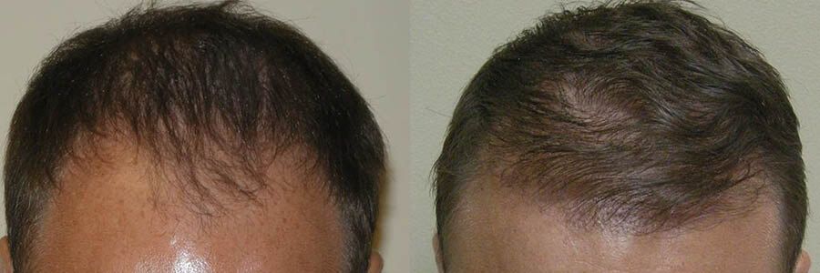 41 Year Old Caucasian Male Brown FUT Hair Transplant Before/After Result