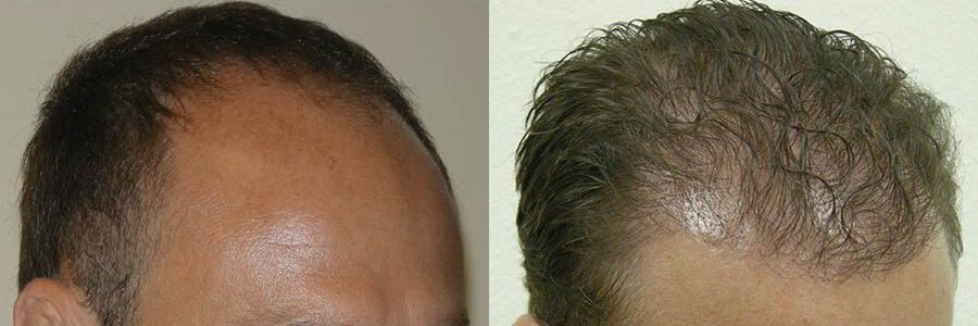 48 Year Old Caucasian Male Brown FUT Hair Transplant Before/After Example