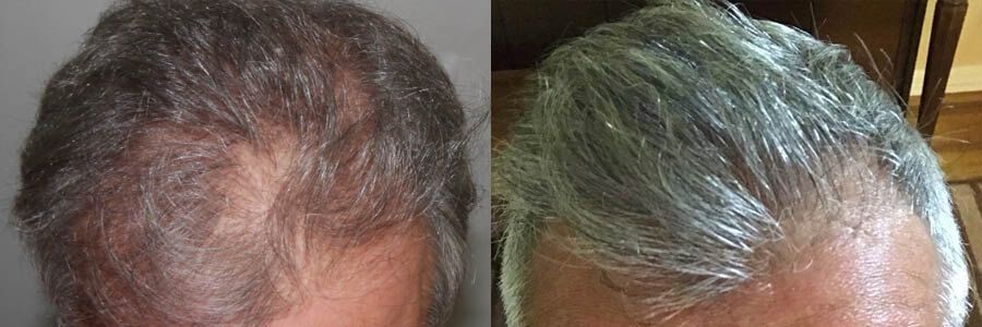 61 Year Old Caucasian Male Gray FUE Hair Transplant Before/After Result