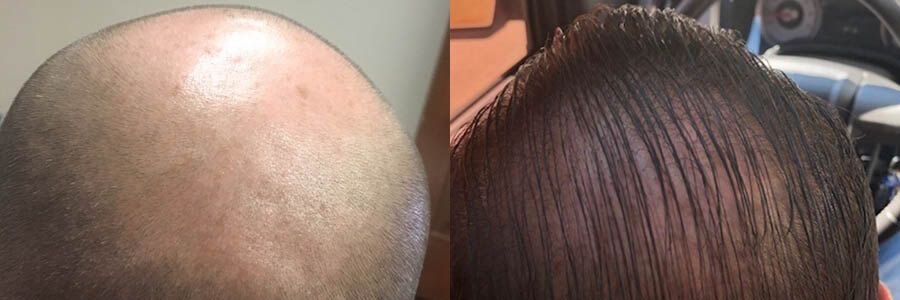 46 Year Old Caucasian Male Brown FUT Hair Transplant Before/After Example