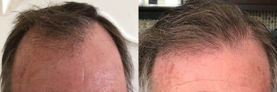 57 Year Old Caucasian Male Brown FUT Hair Transplant Before/After Result
