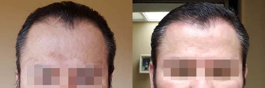 53 Year Old Caucasian Male Black FUT Hair Transplant Before/After Result -  Hair Restoration Centers