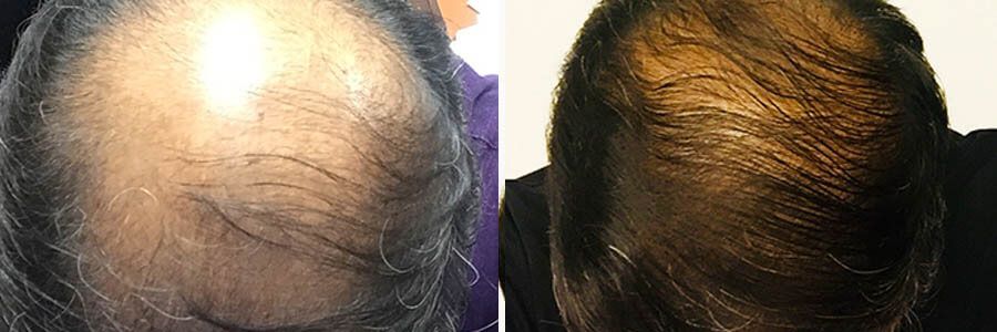 FUT Hair Transplant - Male Before and Afterr