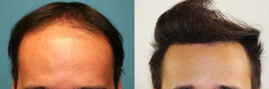 36 Year Old Caucasian Male Brown FUT Hair Transplant Before / After Example