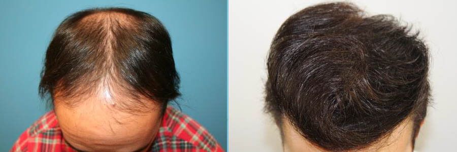FUT Hair Transplant - Female Before and After