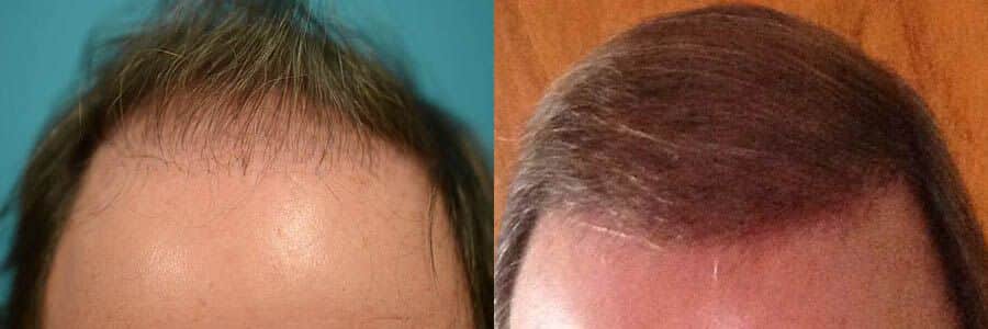 39 Year Old Caucasian Male Blonde FUT Hair Transplant Before / After Result