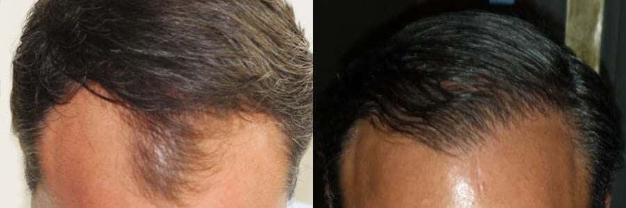 61 Year Old Caucasian Male Brown FUT Hair Transplant Before / After Example