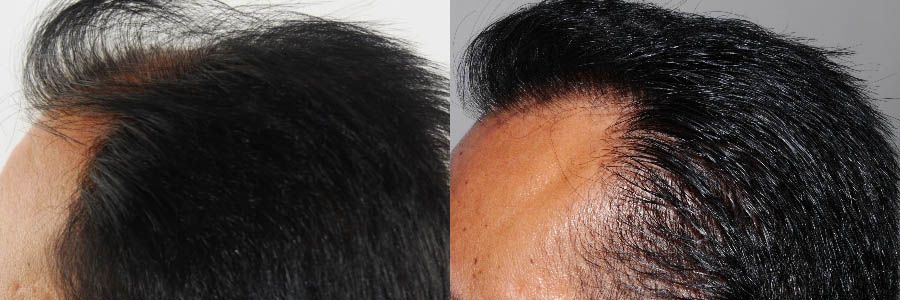 FUT Hair Transplant - Male Before and After