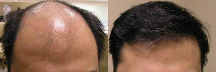 41 Year Old Caucasian Male Black FUT Hair Transplant Before / After Result