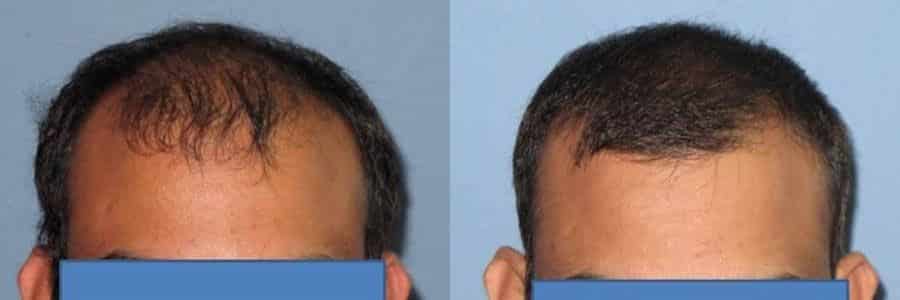 43 Year Old Indian Male Brown FUT Hair Transplant Before / After Example