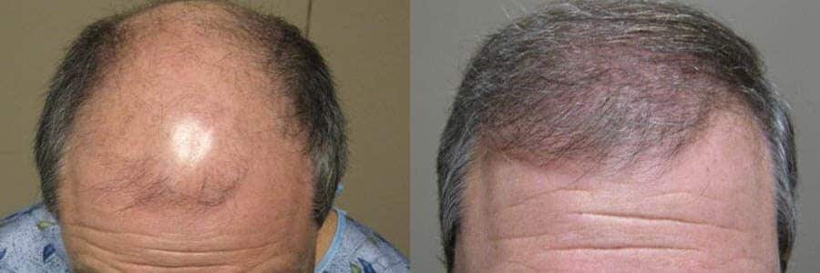 68 Year Old Caucasian Male Black/Gray FUT Hair Transplant Before / After Result