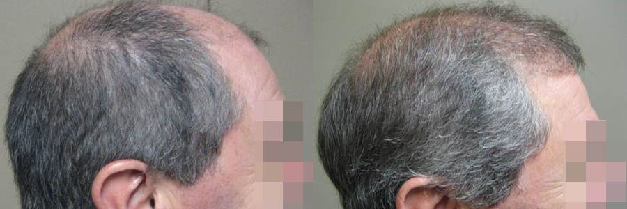 Hair Restoration Center Patient Before and After