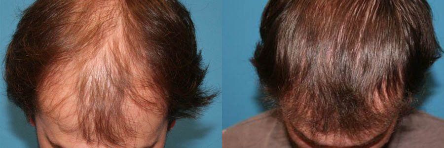 27 Year Old Caucasian Male Brown FUT Hair Transplant Before / After Result
