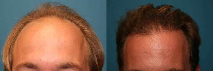 40 Year Old Caucasian Male Blonde FUT Hair Transplant Before / After Example
