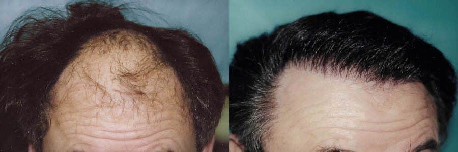 56 Year Old Caucasian Male Brown FUT Hair Transplant Before / After Example