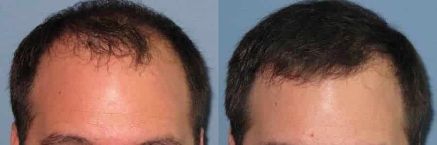 44 Year Old Caucasian Male Brown FUT Hair Transplant Before / After Result